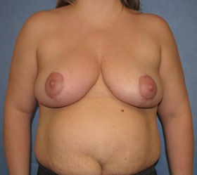 Breast Reduction