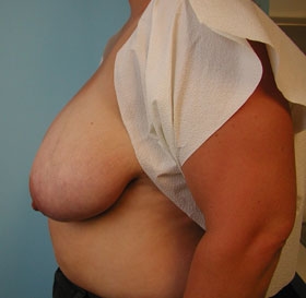 Breast Reduction/Breast Lift