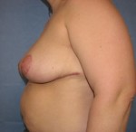 Breast Reduction/Breast Lift