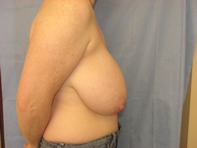 Breast Reduction