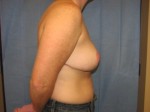Breast Reduction/Breast Lift