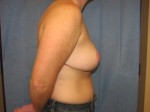 Breast Reduction