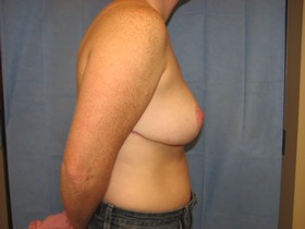 Breast Reduction/Breast Lift