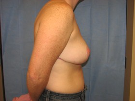 Breast Reduction