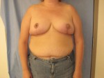 Breast Reduction/Breast Lift