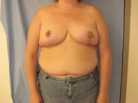 Breast Reduction