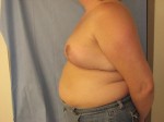 Breast Reduction/Breast Lift