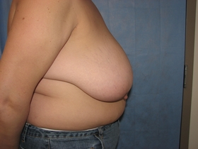 Breast Reduction