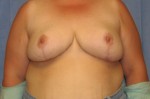 Breast Reduction