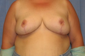 Breast Reduction