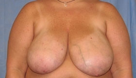 Breast Reduction/Breast Lift