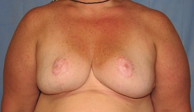 Breast Reduction/Breast Lift