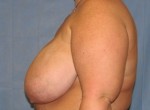 Breast Reduction/Breast Lift