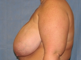 Breast Reduction/Breast Lift