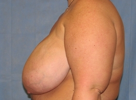 Breast Reduction