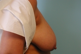 Breast Reduction/Breast Lift