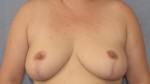 Breast Reduction