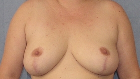 Breast Reduction