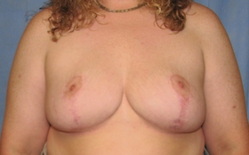 Breast Reduction/Breast Lift