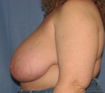 Breast Reduction/Breast Lift