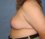 Breast Reduction/Breast Lift