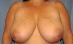Breast Reduction/Breast Lift