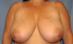 Breast Reduction