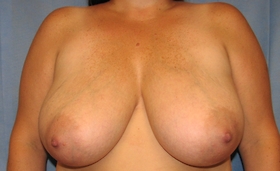 Breast Reduction/Breast Lift