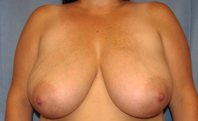 Breast Reduction