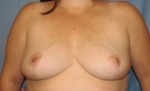 Breast Reduction/Breast Lift
