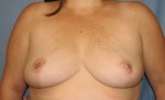 Breast Reduction