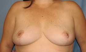 Breast Reduction/Breast Lift