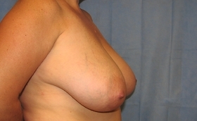 Breast Reduction/Breast Lift