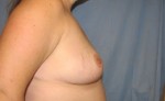 Breast Reduction/Breast Lift