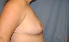 Breast Reduction/Breast Lift