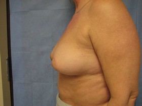 Breast Reconstruction