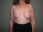 Breast Reconstruction