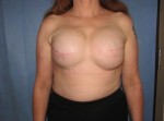 Breast Reconstruction