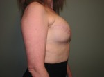 Breast Reconstruction