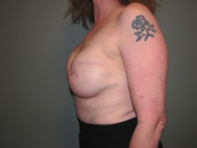 Breast Reconstruction