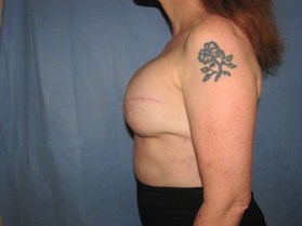 Breast Reconstruction