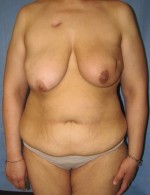 Breast Reconstruction