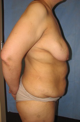 Breast Reconstruction