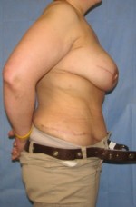 Breast Reconstruction