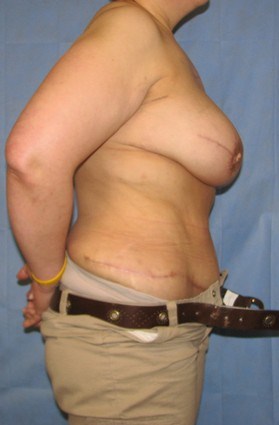 Breast Reconstruction