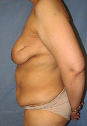 Breast Reconstruction