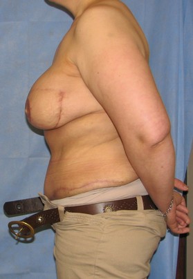 Breast Reconstruction