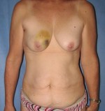 Breast Reconstruction