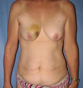 Breast Reconstruction