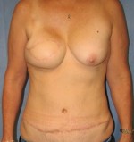 Breast Reconstruction